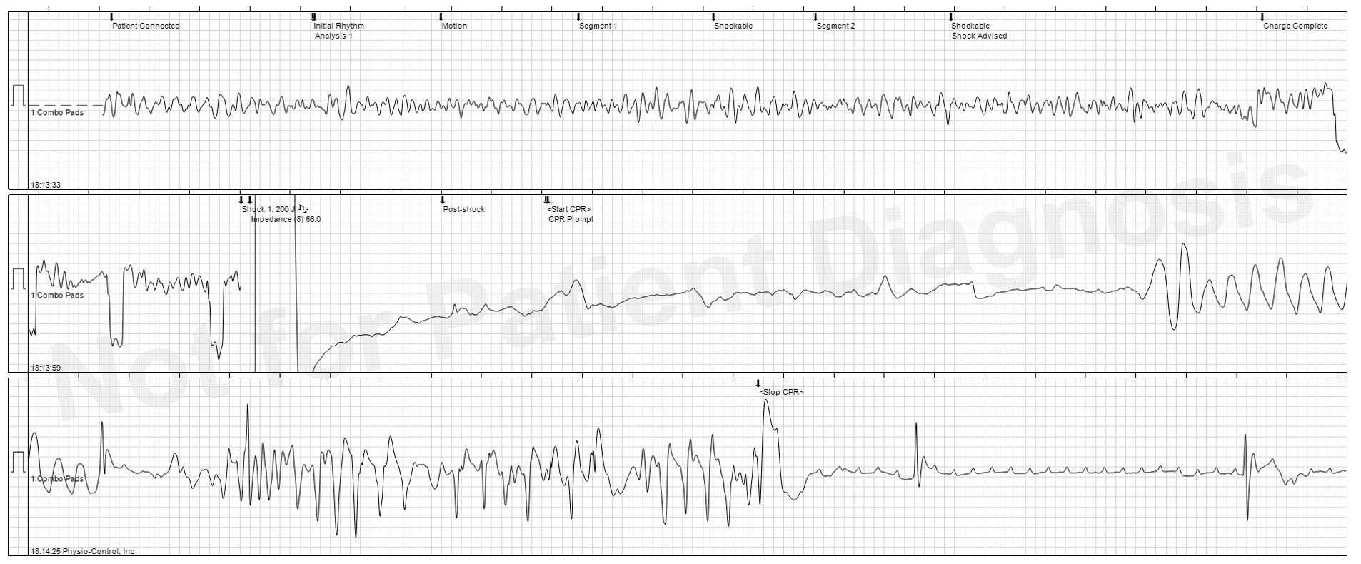 AED picture - cardiac arrest 